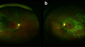 Atrofia coriorretiniana pigmentada paravenosa