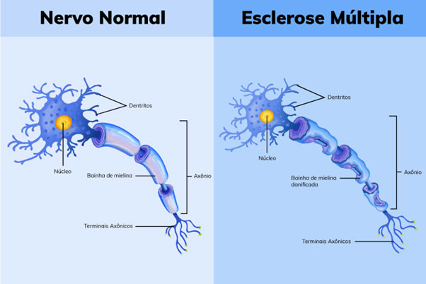 esclerose multipla 01