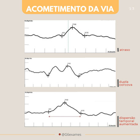 esclerose multipla 02