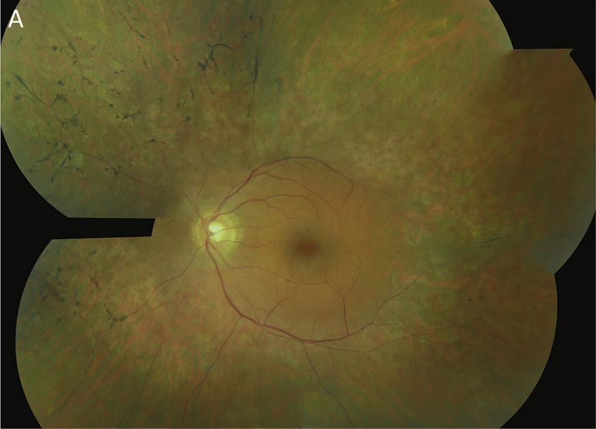 retinose pigmentaria 01